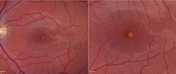 Foveal lesion, magnified on right side
